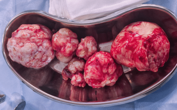 Understanding Fibroids