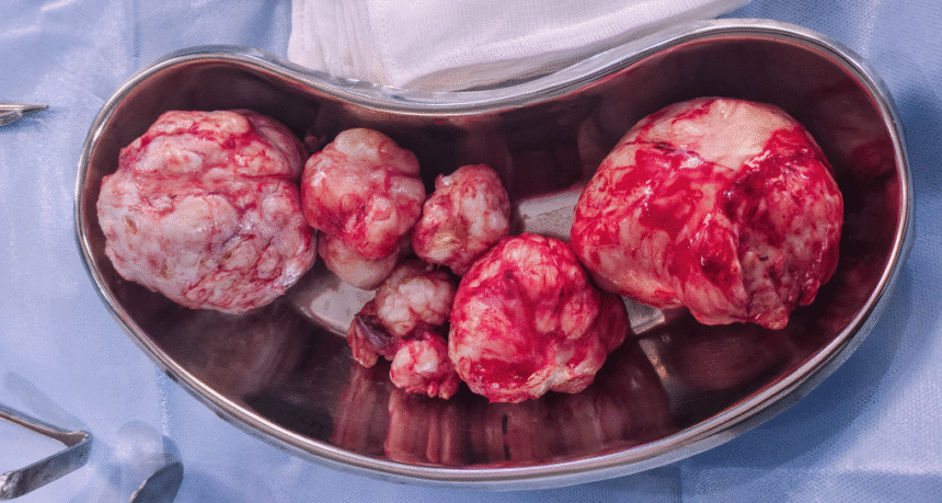 Understanding Fibroids